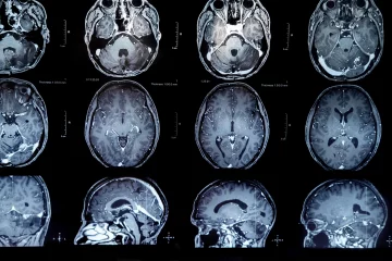 beyin tümörü tanı ve tedavisi