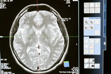 travmatik beyin hasarı kimlerde görülür