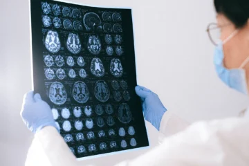 travmatik beyin hasarı nedir? travmatik beyin hasarı nasıl anlaşılır?